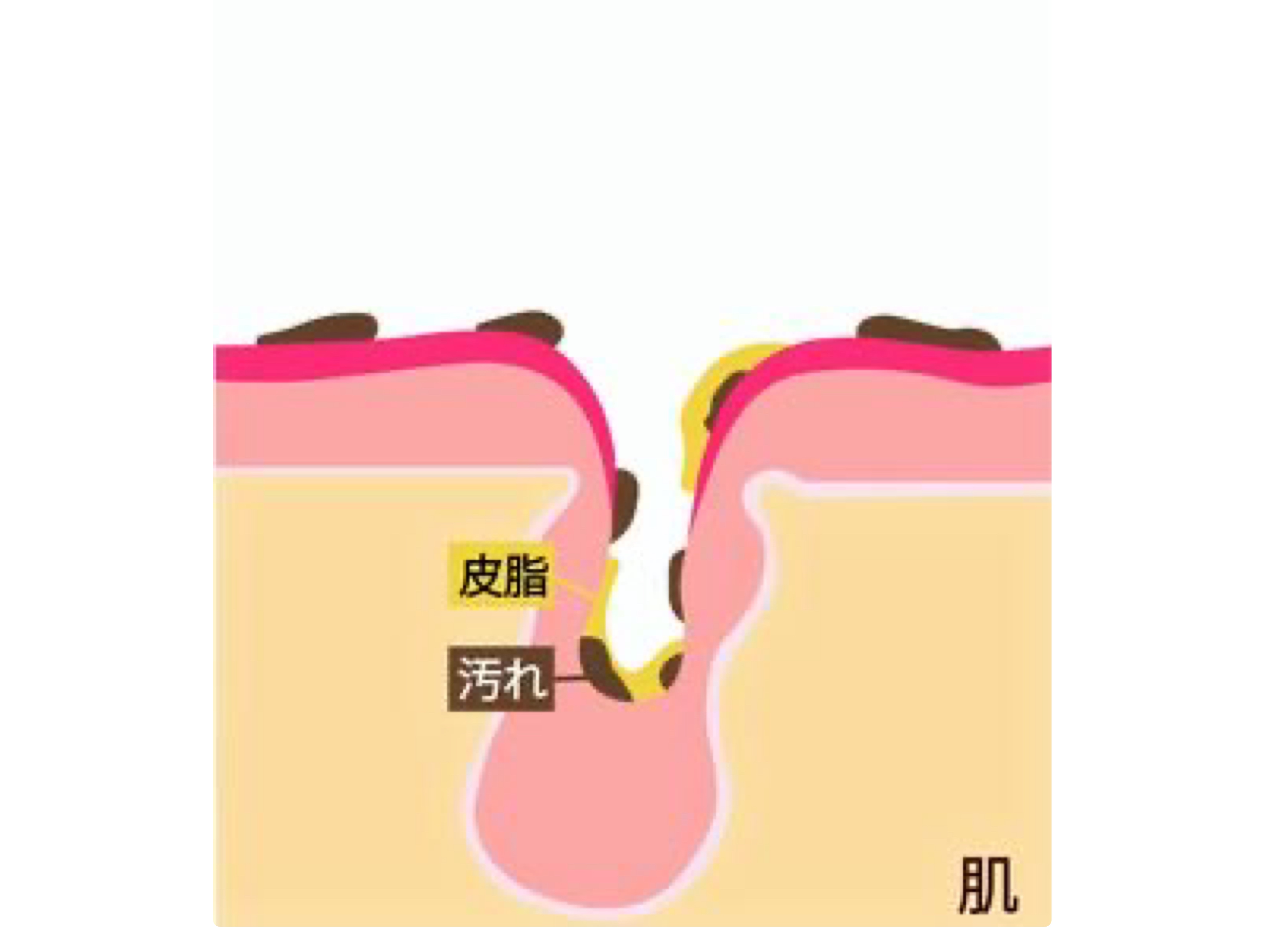 ニキビ