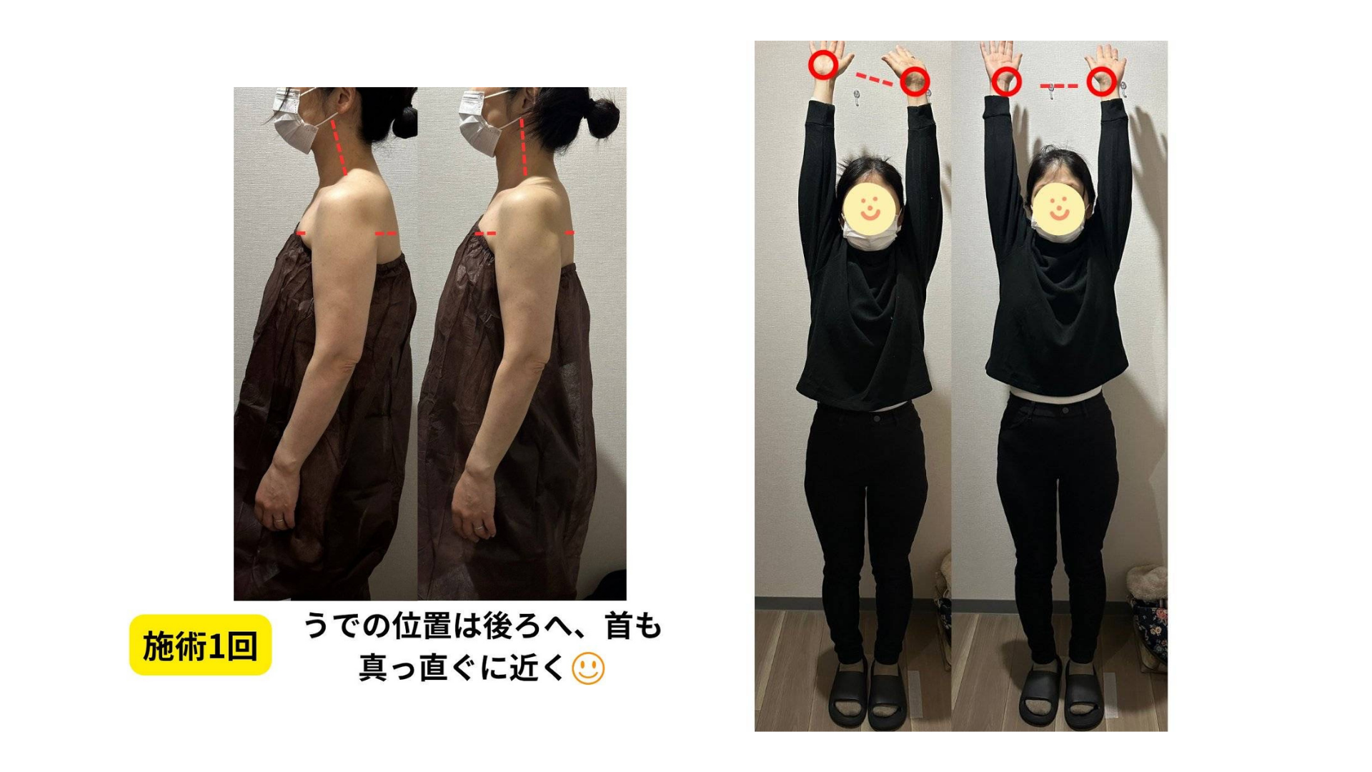 肩こり